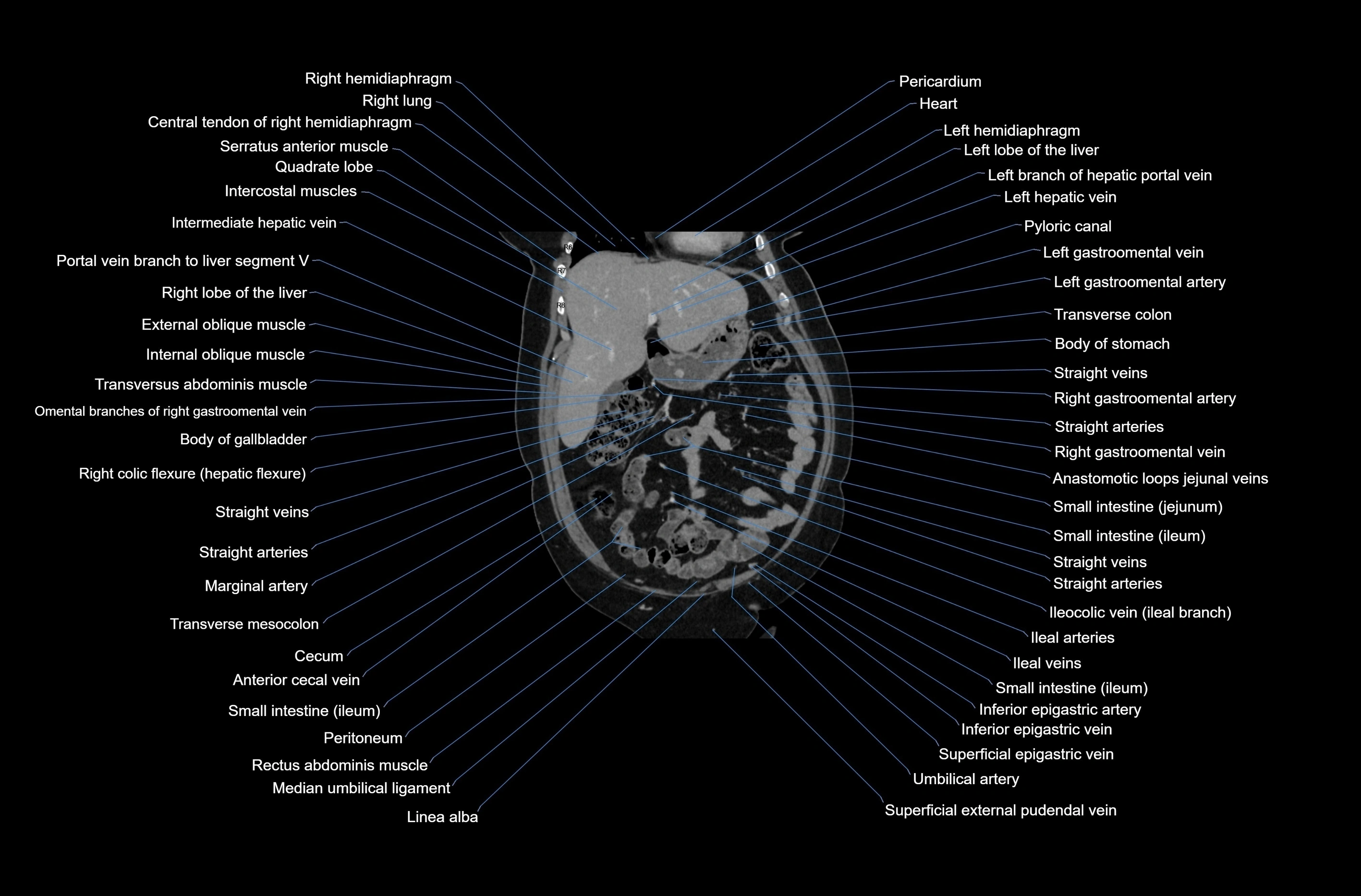CT abdomen coronal cross sectional anatomy labelled radiology image-00024.webp
